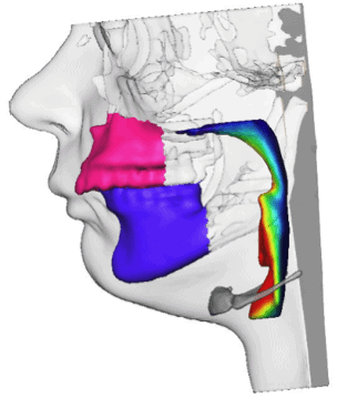 Abbildung 3: Simulation der Atemwege und des ästhetischen Ergebnisses. Vorher-Nachher Simulation